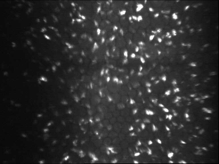 Microscopía especular confocal patológica (córnea farinata)